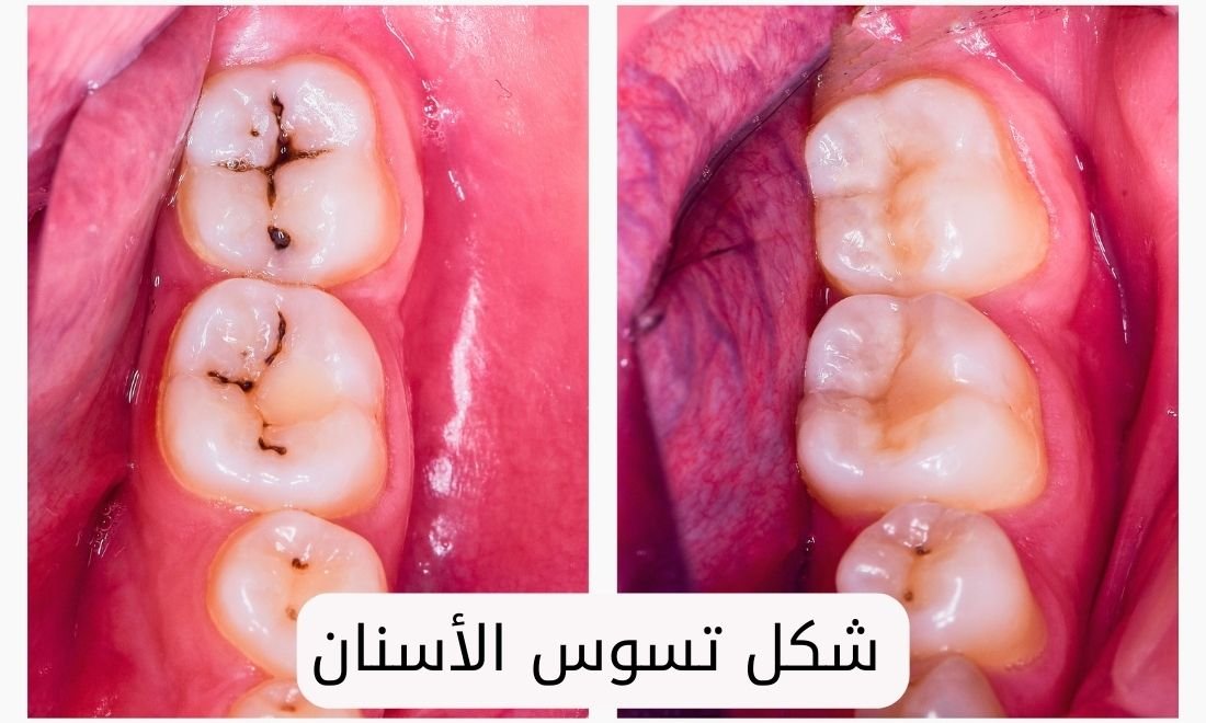 تسوس الاسنان للاطفال: الأسباب وطرق العلاج 2026 - Tbeby - طبيبي