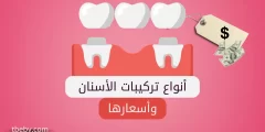 أنواع تركيبات الأسنان وأسعارها في السعودية