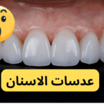 عدسات الاسنان