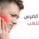 خلع الضرس الملتهب