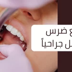 خلع ضرس العقل جراحيا