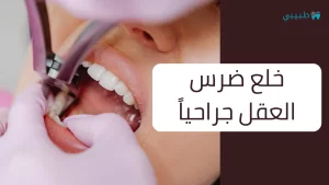 خلع ضرس العقل جراحيا