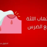 علاج التهاب اللثة بعد خلع الضرس