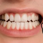 سوء إطباق الأسنان