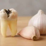 علاج تسوس الأسنان بالثوم