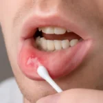 علاج-تقرحات-الفم-المتكررة
