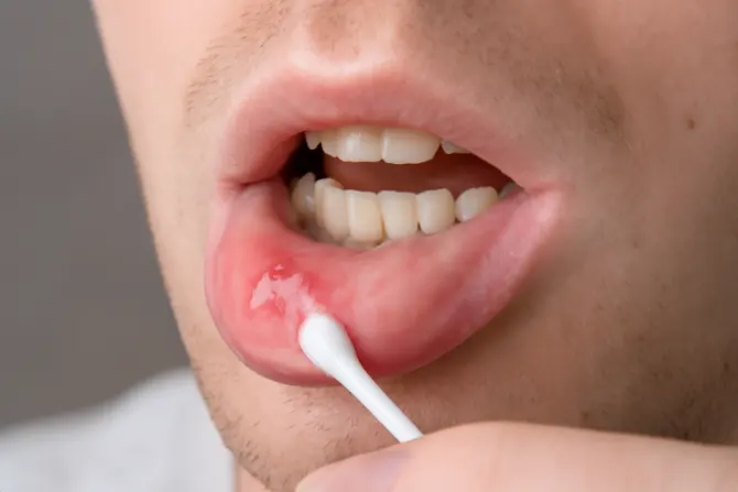 علاج-تقرحات-الفم-المتكررة