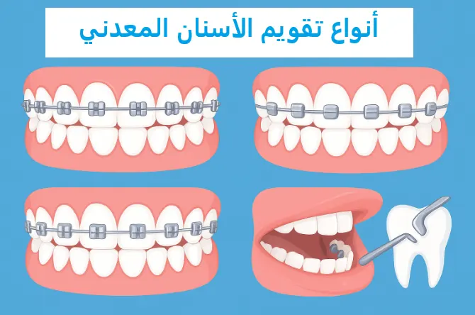 أنواع تقويم الأسنان المعدني