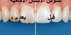 تسوس الاسنان الامامية قبل وبعد: الأعراض وأفضل طرق العلاج في مصر