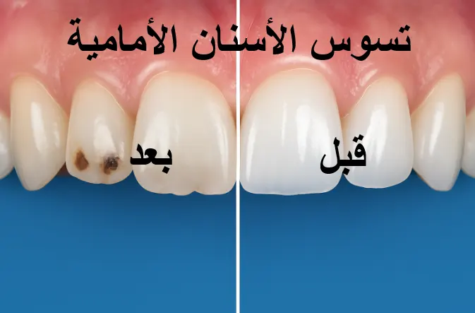 تسوس الاسنان الامامية قبل وبعد