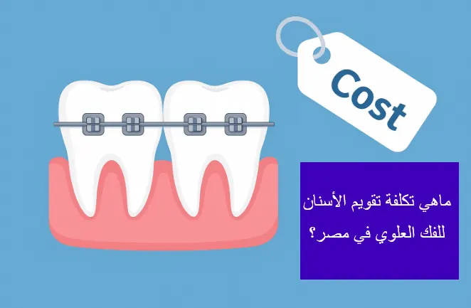 تكلفة تقويم الفك العلوي في مصر