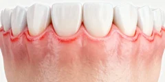 التهابات اللثة اسبابها وعلاجها: دليل شامل للوقاية والعناية