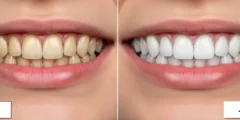 تبييض الأسنان بالليزر قبل وبعد: الخطوات والتكلفة والنتائج