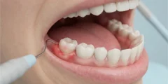 خلع ضرس العقل وهو ملتهب: الأسباب وخطوات العلاج