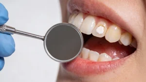 ما هو تسوس الأسنان الأمامية؟
