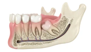 ما هو الضرس المدفون؟