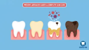 At-Home Tooth Filling Methods