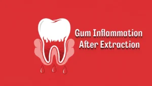 Gum Inflammation After Extraction