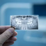 Surgical Wisdom Tooth Extraction
