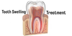 Tooth Swelling Treatment