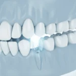 Wisdom Tooth Extraction