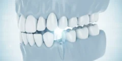 Wisdom Tooth Extraction: Side Effects, Recovery