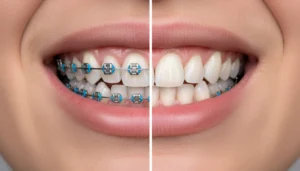 Prerequisites for Dental Braces Installation