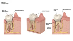 متى يظهر ضرس العقل؟