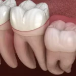 Wisdom Tooth Extraction Cost: Everything You Need to Know