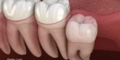 Wisdom Tooth Extraction Cost: Everything You Need to Know