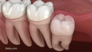 Wisdom Tooth Extraction Cost: Everything You Need to Know