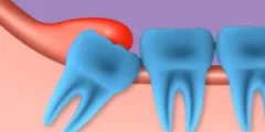 Treating an Abscessed Filled Tooth: Best Methods and Causes 2026 Treating an Abscessed Filled Tooth: Best Methods and Causes 2026