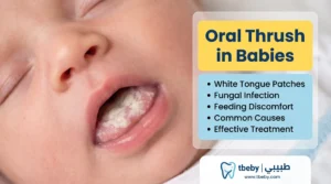 2. Oral Thrush (White Tongue)