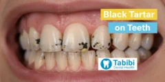 Black Tartar on Teeth – Risks, Causes & Prevention Guide 2026