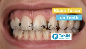 Black Tartar on Teeth – Risks, Causes & Prevention Guide 2026