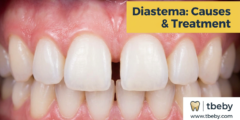 Diastema: Causes of Dental Gaps and the Best Treatment Options in 2026 Diastema: Causes of Dental Gaps and the Best Treatment Options in 2026