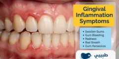 Gingival Inflammation: 6 Common Symptoms, Causes, and Treatment Methods Gingival Inflammation: 6 Common Symptoms, Causes, and Treatment Methods