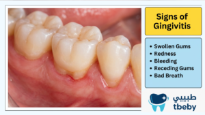 Gingival Inflammation Symptoms: 6 Key Signs to Recognize