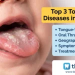 Top 3 Tongue Diseases in Infants 2026