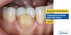 Exposed Tooth Nerve Treatment at Home and with Herbs 2026 Exposed Tooth Nerve Treatment at Home and with Herbs 2026