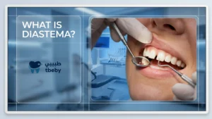 What Is Diastema?