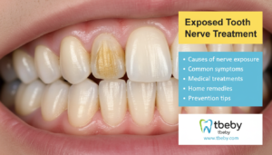What Is an Exposed Tooth Nerve?