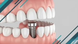 Why Do People Choose Dental Implants?