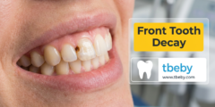 4 Most Important Treatments for Front Tooth Decay in 2026