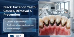 Black Tartar on Teeth – Risks, Causes & Prevention Guide 2026