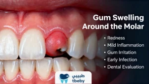 Gum Swelling Under the Molar