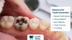 Reasons for Tooth and Molar Extraction