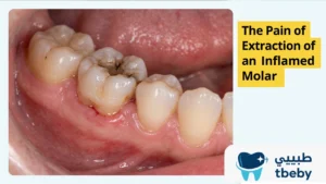 The Pain of Extraction of an Inflamed Molar
