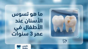 ما هو تسوس الأسنان عند الأطفال في عمر 3 سنوات