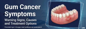 Gum Cancer Symptoms: Causes and Available Treatment Options